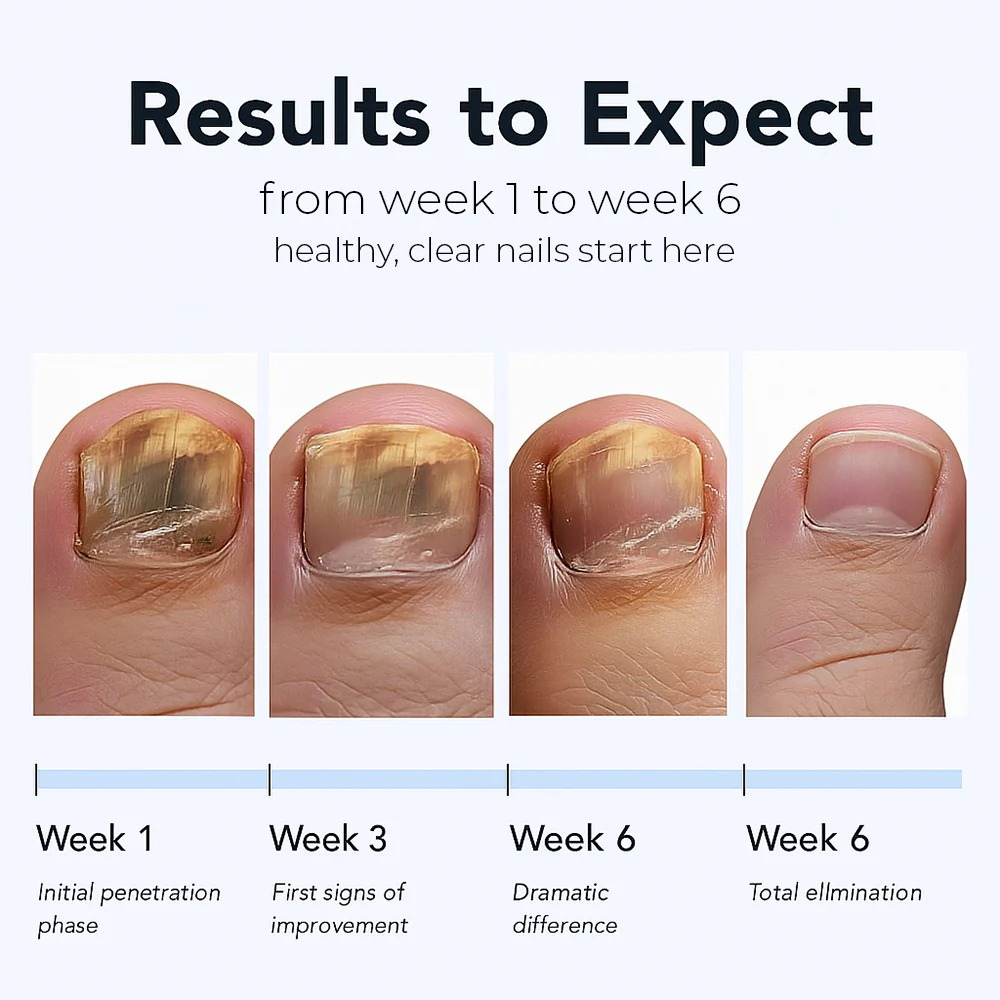 Natravor™ Fungal Nail Renewal Patches