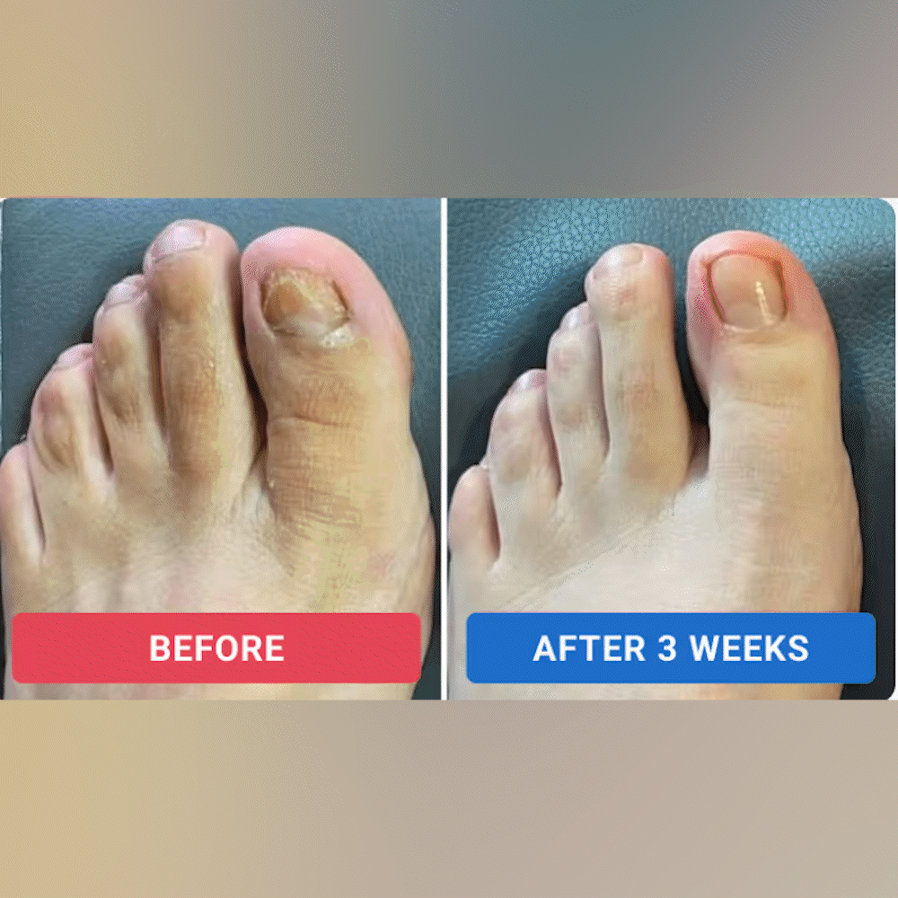 Natravor™ Fungal Nail Renewal Patches