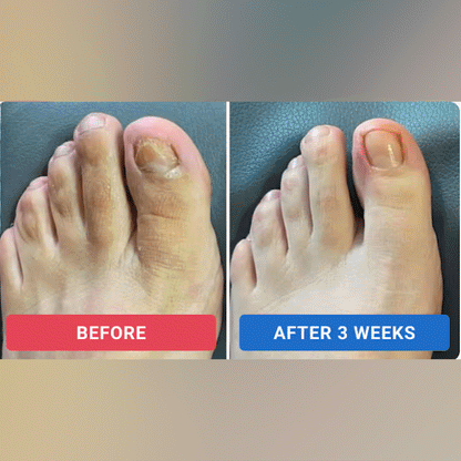 Natravor™ Fungal Nail Renewal Patches